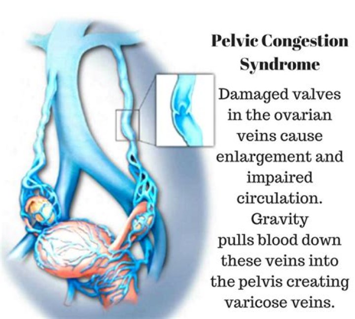 What is pelvic venous congestion syndrome